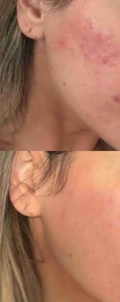 Acne & post-acne marks — before treatment