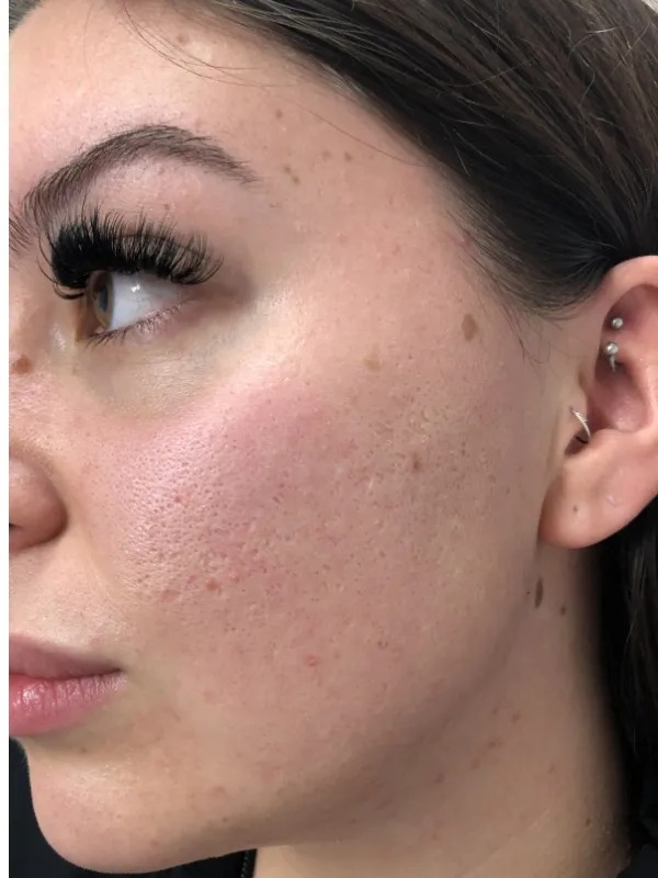 Acne scars & texture — after treatment